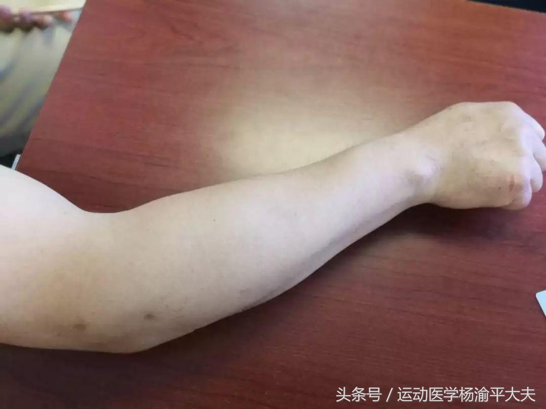 顽固性网球肘治疗,打网球的想法