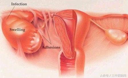 盆腔炎危害是什么,盆腔炎会不会宫外孕
