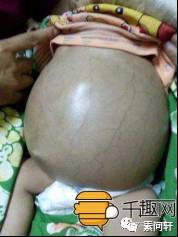 像蚯蚓一样的凸起的纹,像蚯蚓一样黑色的是什么