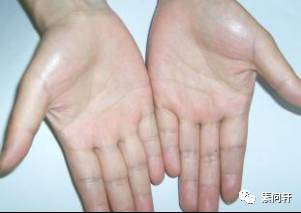 像蚯蚓一样的凸起的纹,像蚯蚓一样黑色的是什么