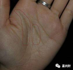 像蚯蚓一样的凸起的纹,像蚯蚓一样黑色的是什么