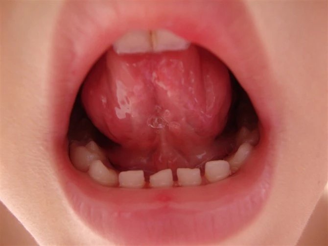 预防手足口病,预防手足口病动画视频