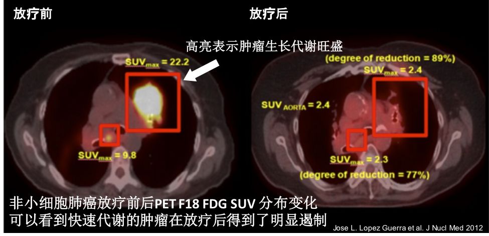 美国放疗现状,从确诊到化疗要几天