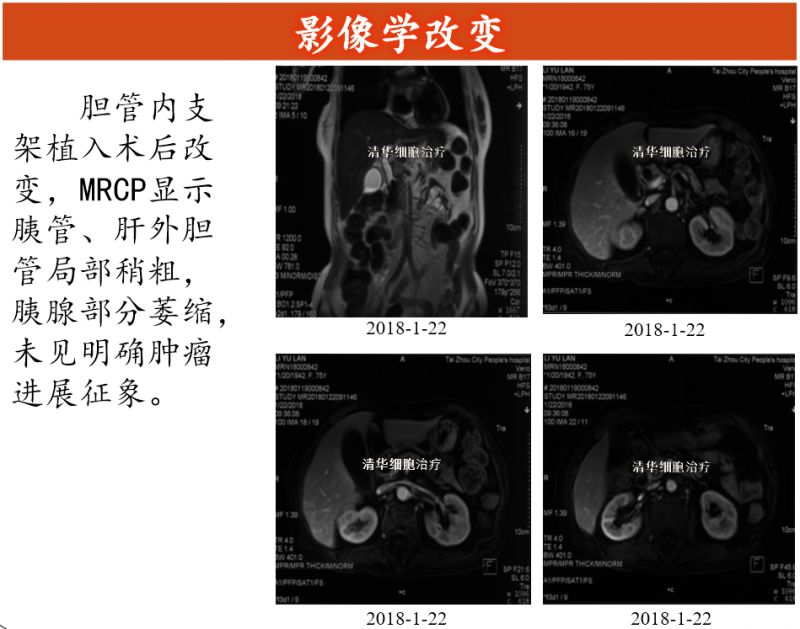胰腺癌lla期,胰腺癌sbrt能治愈吗