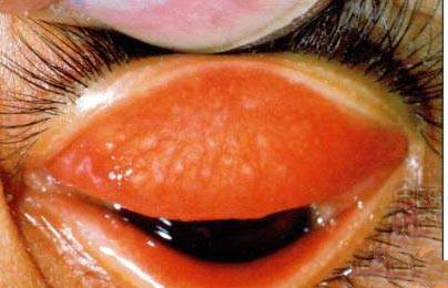 女性沙眼衣原体感染的危害,沙眼的危害和治疗方法