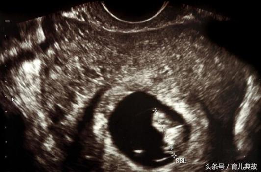 26岁双胎孕妇,27岁的孕妈妈怀孕双胞胎b超单