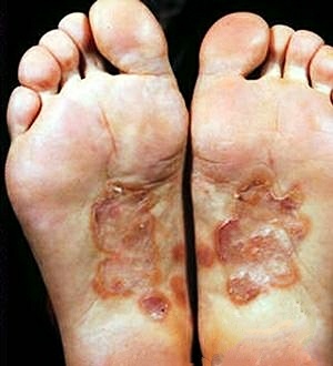 产检梅毒阴性是正常吗,孕妇产检梅毒阳性是怎么回事