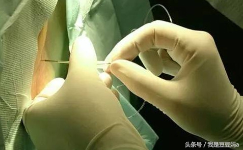 无痛分娩的妈妈亲身体验,无痛分娩9件事