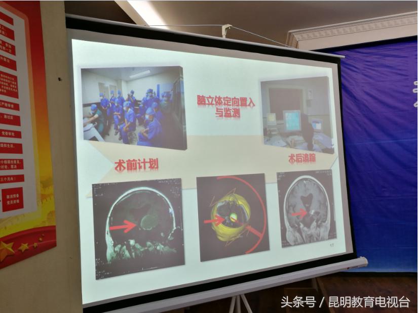 昆明军海医院脑病治疗新突破偏远地区青少年患者将受益