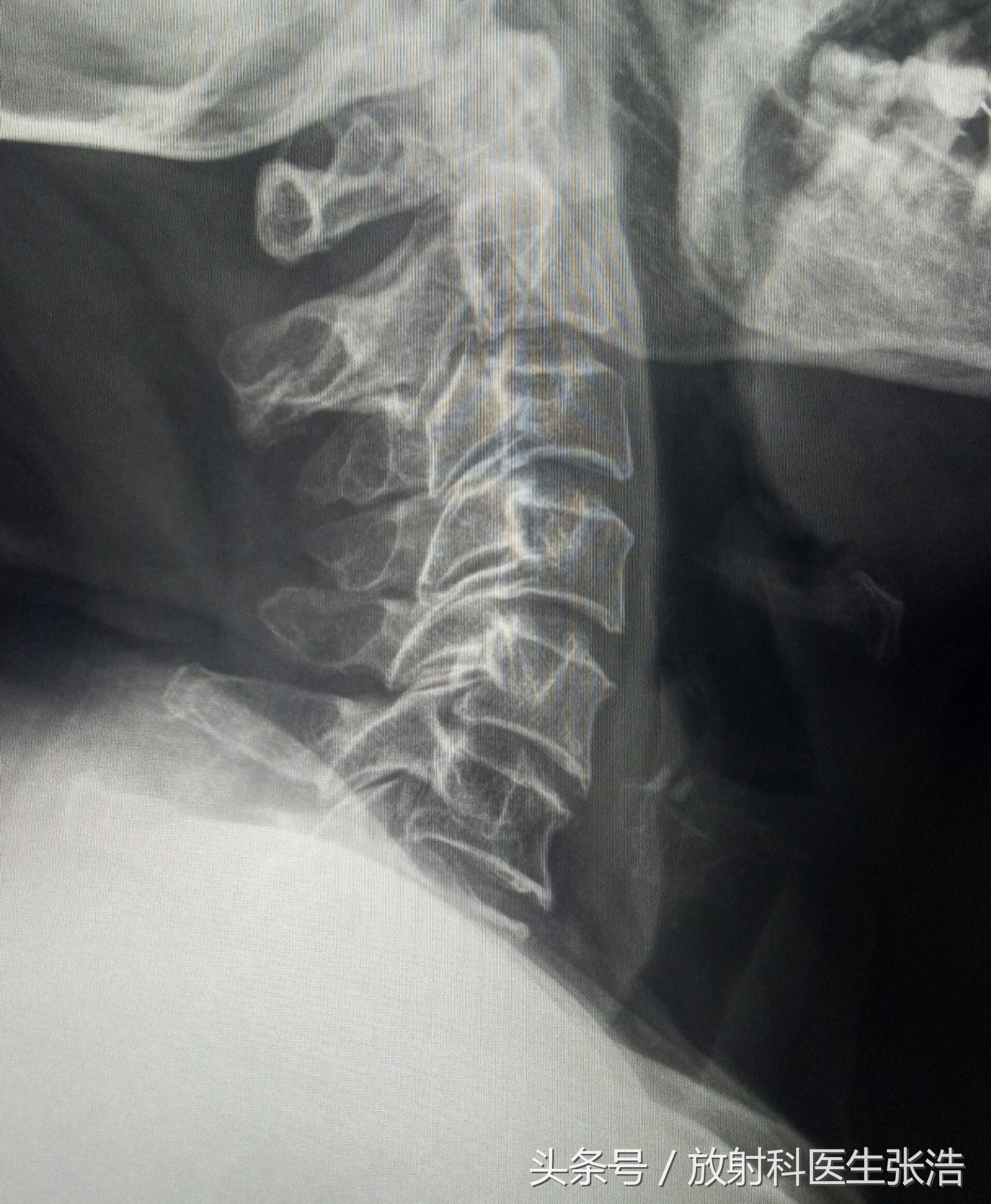 腰椎骨质增生的影像表现,颈椎骨质增生影像视频