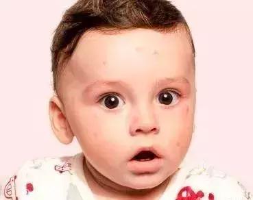 麻疹水痘手足口病皮疹的鉴别方法,麻疹水痘猩红热的出疹时间