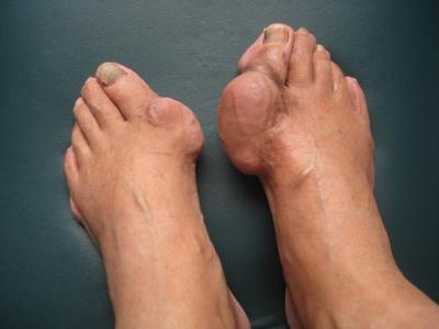 痛风和尿酸高可以吃哪几种菜,痛风吃什么菜可以降尿酸