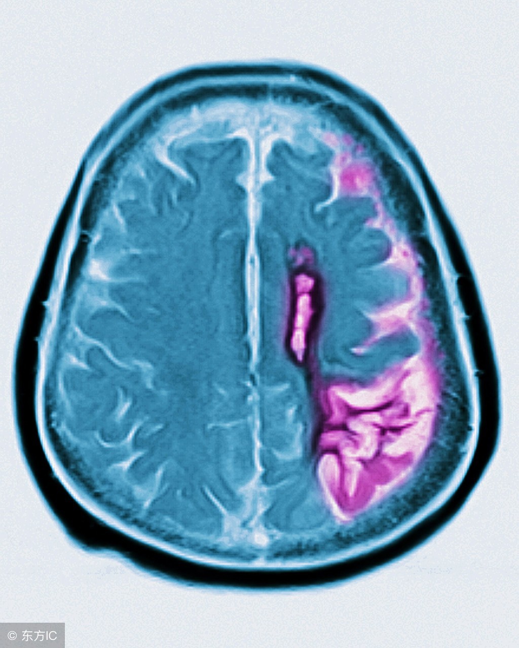 脑萎缩注意事项及防护,脑萎缩注意哪些事项