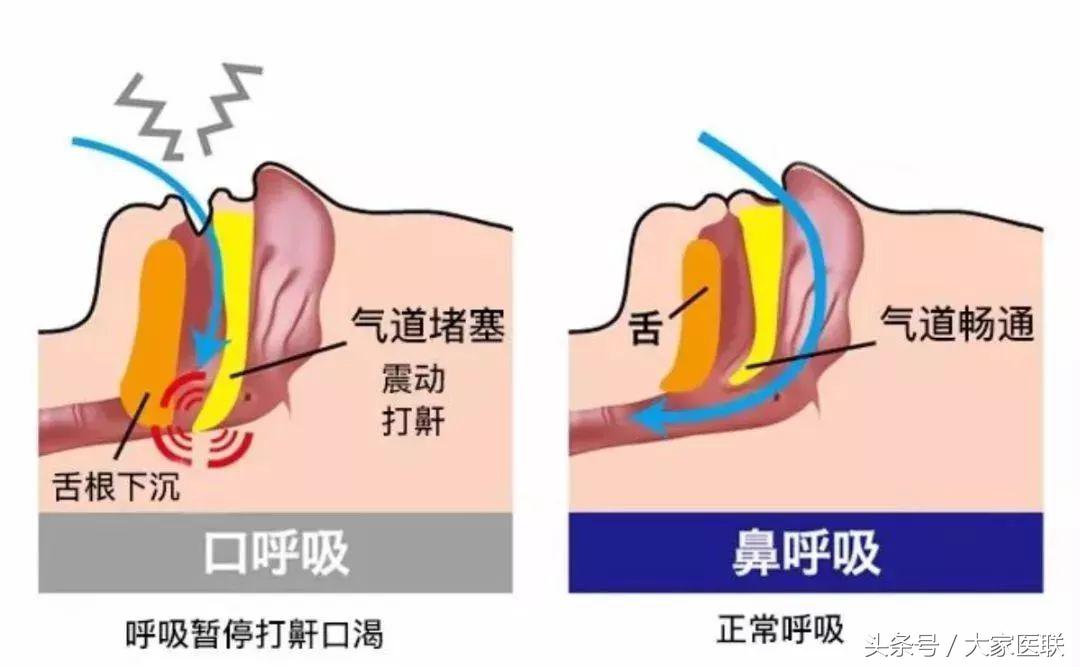 贴嘴胶布矫正口呼吸用哪个更好,成人用口呼吸矫正贴嘴有效吗