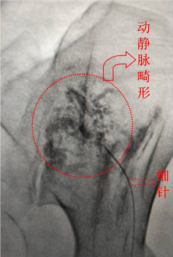 动静脉畸形介入手术后是否能喝酒,无水酒精治疗动静脉畸形