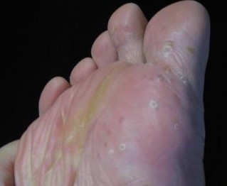 脚气真菌感染怎么越治越厉害,脚气3年了痒的难受怎么治疗