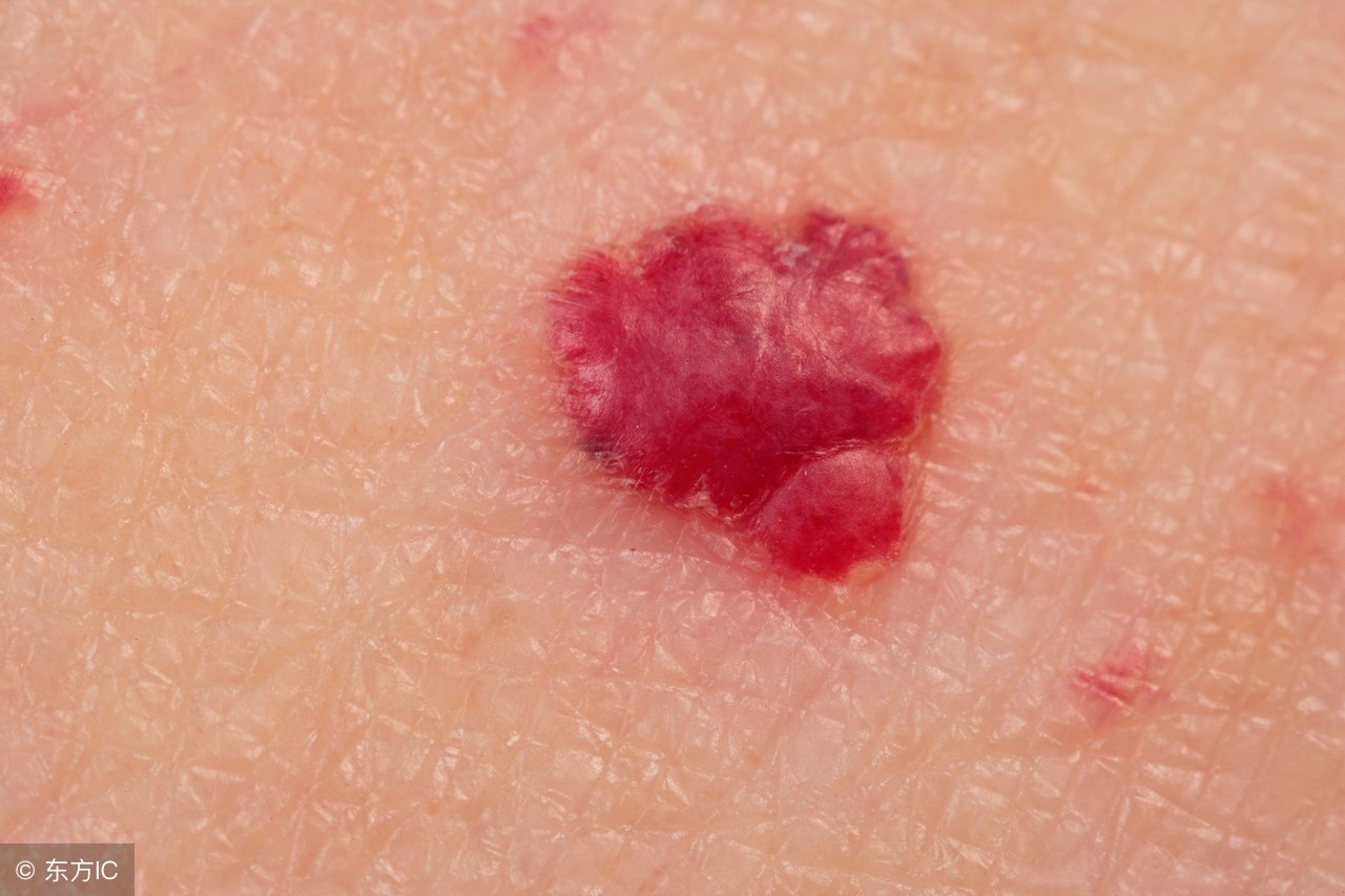 皮肤出现红痣什么原因,皮肤上长红痣要当心是肝病的征兆