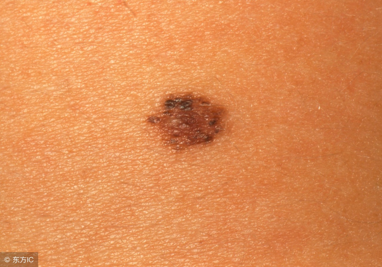 皮肤出现红痣什么原因,皮肤上长红痣要当心是肝病的征兆