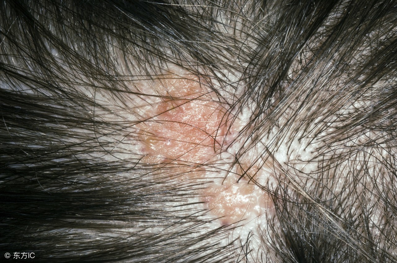 毛囊炎久治不愈会造成什么损伤,头上的毛囊炎久治不愈是什么原因