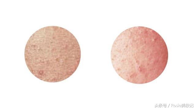 脸上长闭口粉刺应该怎么办,消灭额头粉刺闭口