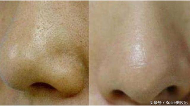 脸上长闭口粉刺应该怎么办,消灭额头粉刺闭口