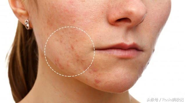 脸上长闭口粉刺应该怎么办,消灭额头粉刺闭口