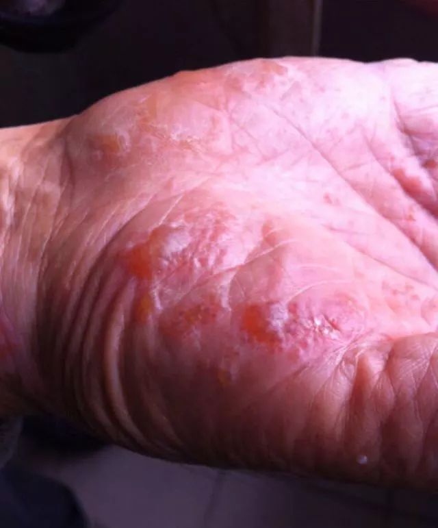 红包有不好的含义吗,额上长疱是什么原因