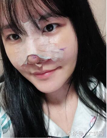 隆鼻后如何克服焦虑,隆鼻后前三天状态