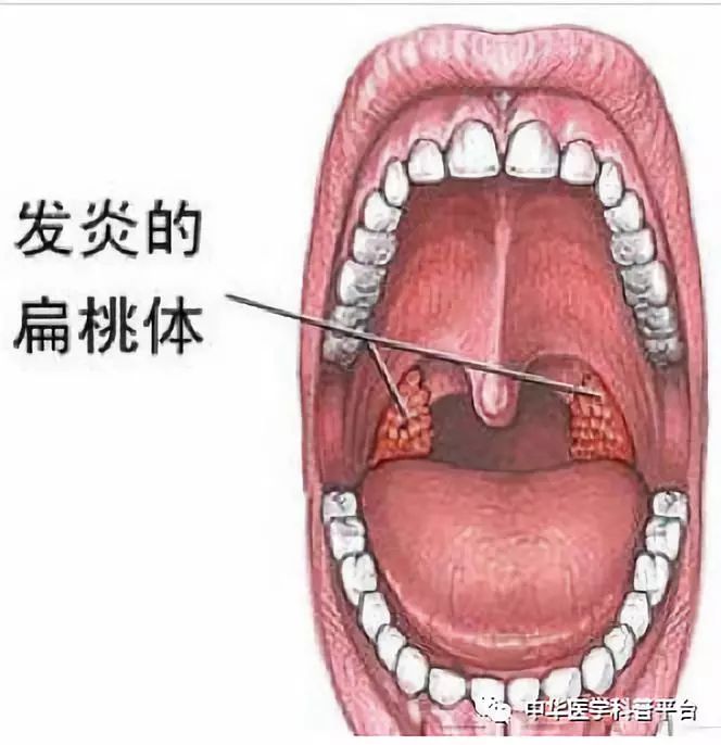 急性扁桃体炎吃阿奇霉素可以吗,急性扁桃体炎吃什么消炎药