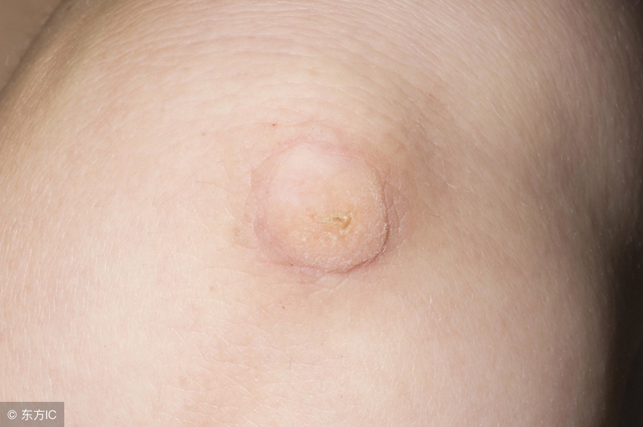 扁平疣发病的原因有哪些,冷冻扁平疣后饮食注意什么