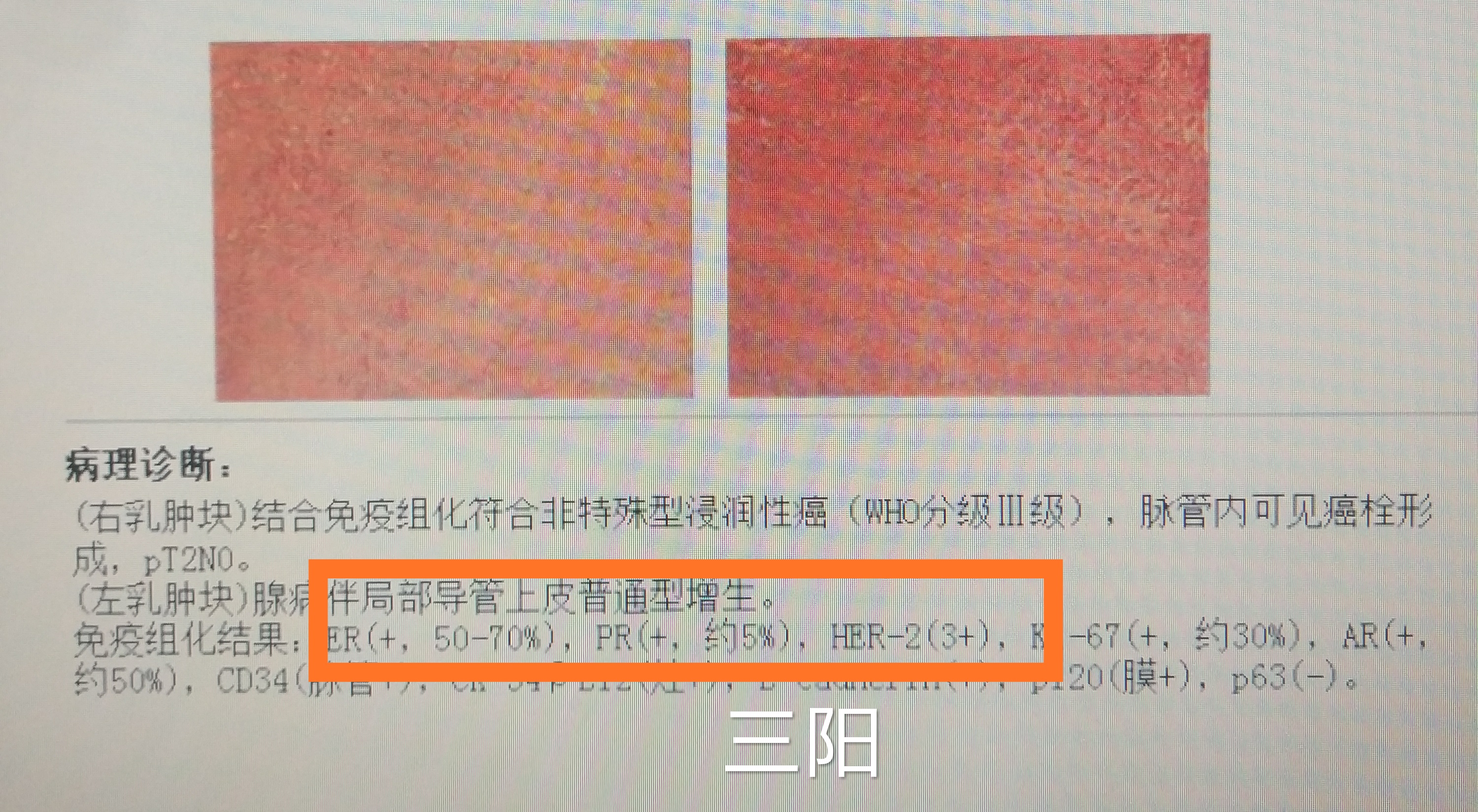 乳腺癌三阴一阳意味着什么,什么是两阳一阴乳腺癌