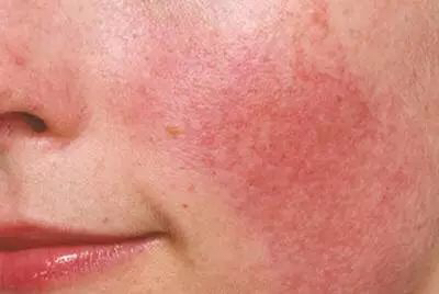 脸部泛红敷面膜刺痛,脸上长痘痘闭口泛红有刺痛皮肤干