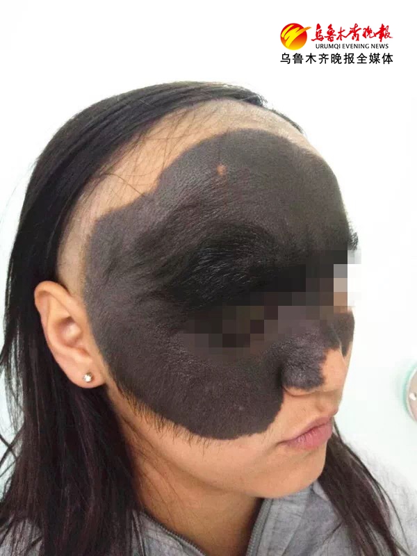 *疆新**一少女被黑毛痣困扰“无脸见人”公益计划助其改写“明天”