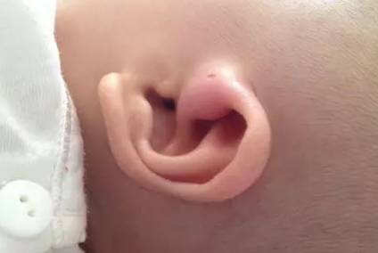 耳朵上有个小洞洞是怎么回事图片,孩子耳朵上的这种小洞该怎么办
