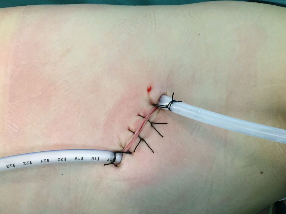 单孔胸腔镜肺癌根治手术获得成功,胸腔镜下肺组织或病灶切除术