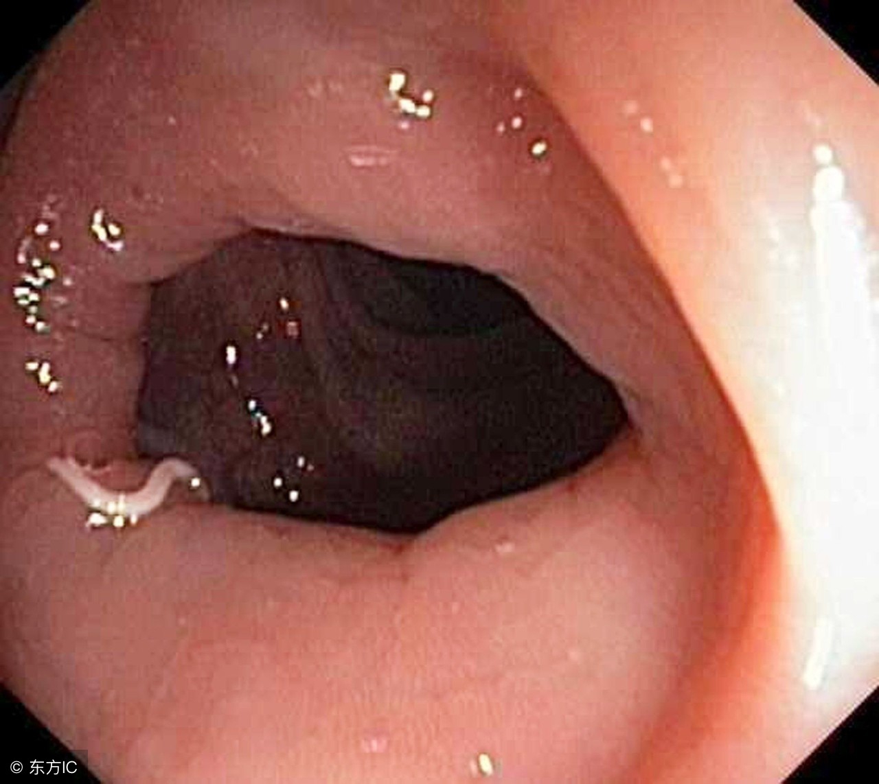 小女孩隐*处私**掉虫子？这个问题不少见
