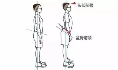腰腿疼竟是骨盆惹的祸,骨盆前倾造成腰腿痛怎么解决