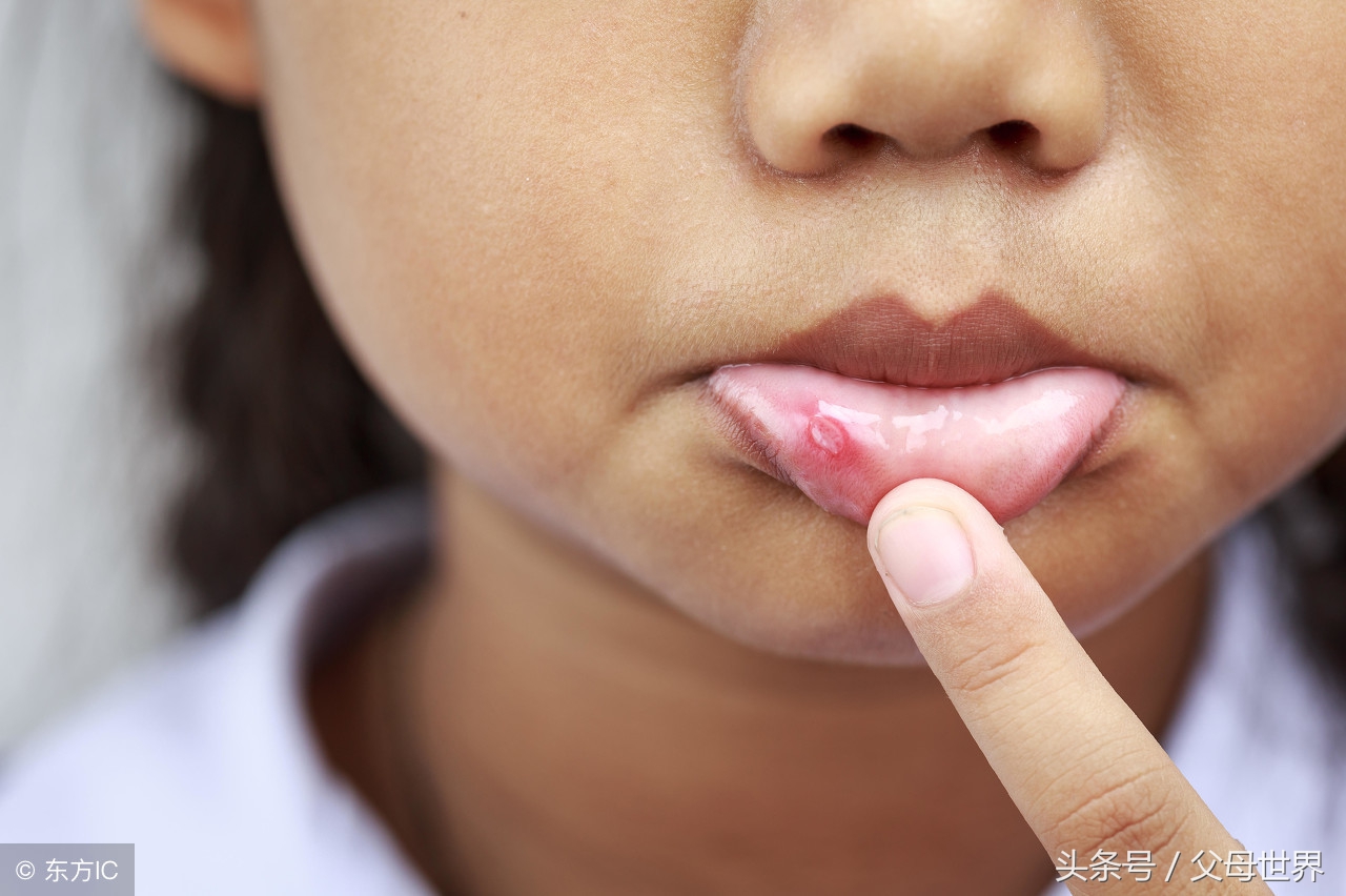宝宝嘴里起溃疡睡不着怎么办,宝宝嘴里溃疡发烧怎么办