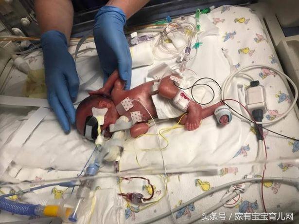 警惕！早产儿会有很多并发症的可能！如何避免？