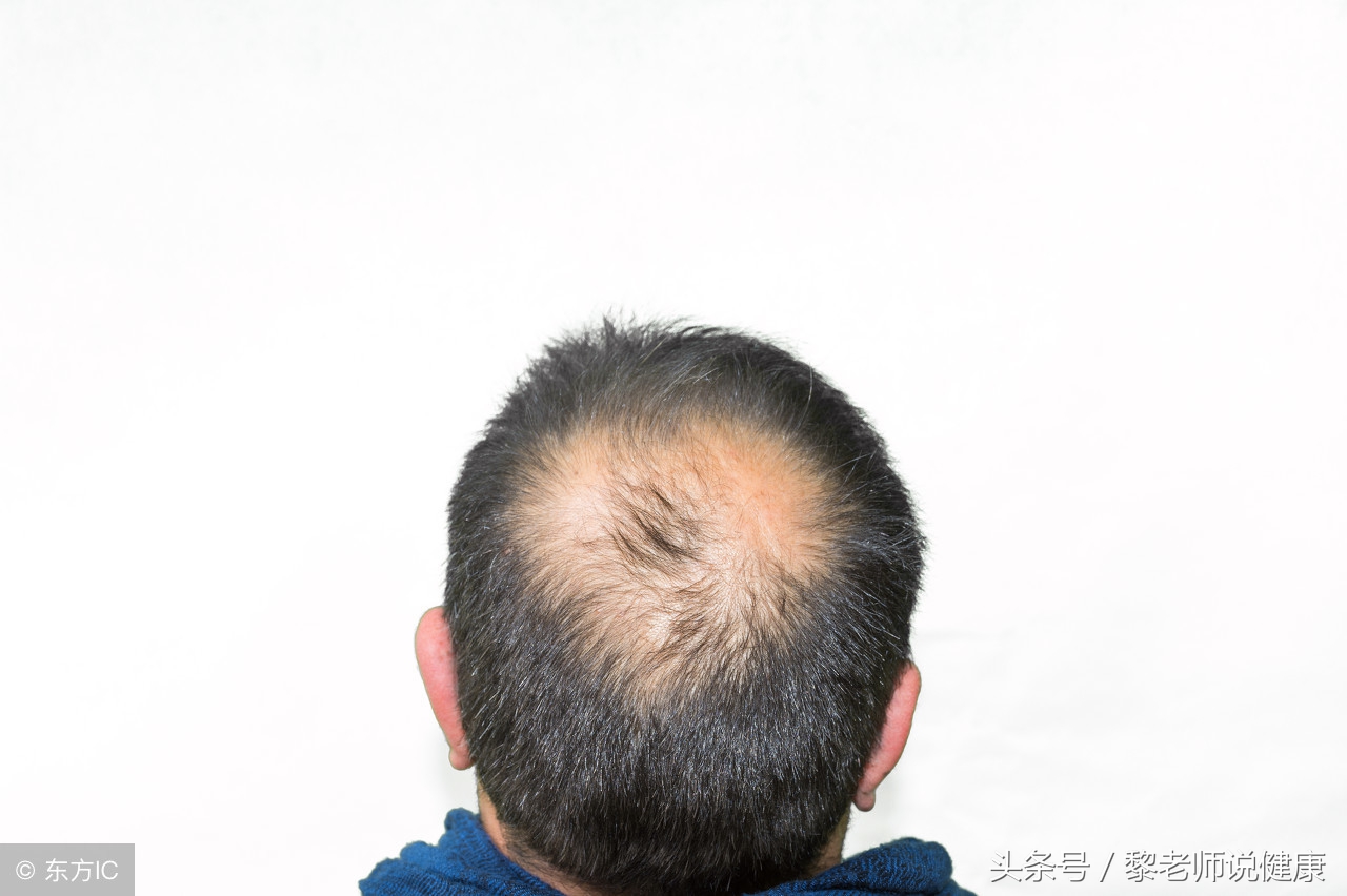脱发掉发快成秃头了要怎么办,防脱发严重长新发