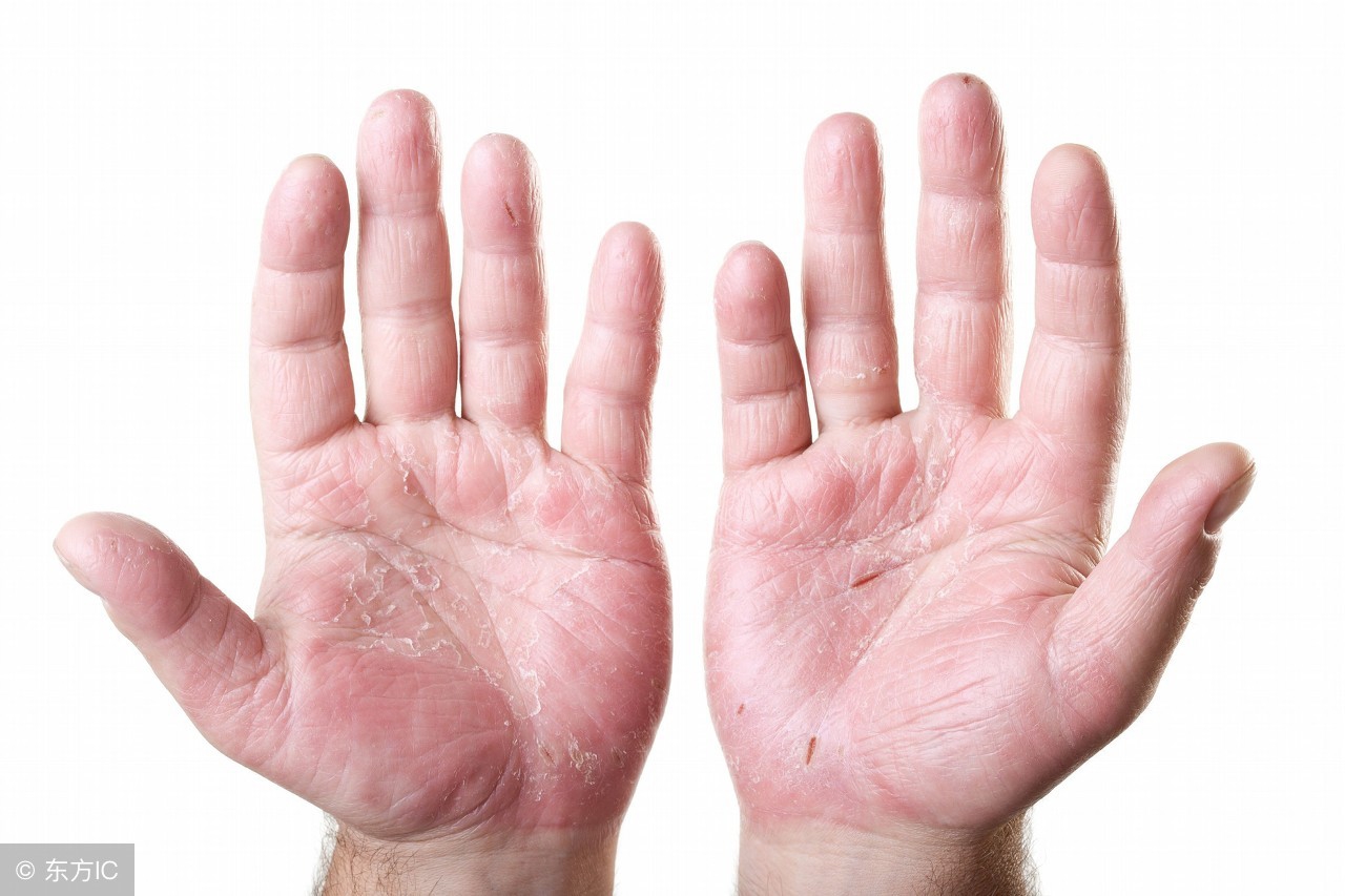 夏天一出汗身上就痒像长痱子,夏天出汗身上长了很多小红疙瘩痒