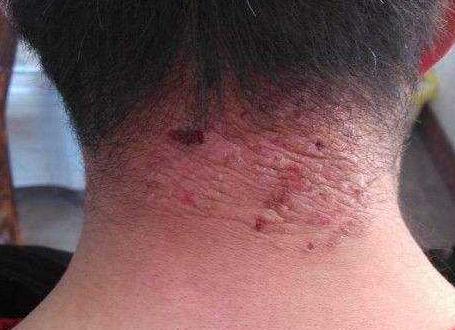 洁尔阴洗剂可以去除螨虫吗,洁尔阴洗液可以擦荨麻疹吗