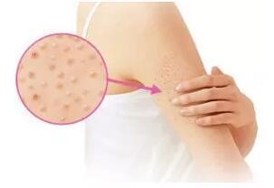 邯郸市丛台区中医院皮肤科医生,拒绝鸡皮肤最有效的方法