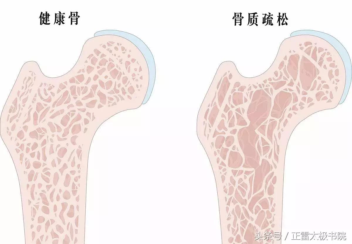 太极拳锻炼身体哪些素质,运动是防治骨质疏松的有效方法