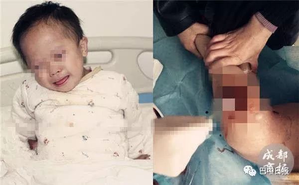 还记得患重病左腿3个大窟窿的通江男童吗?有他的最新消息了!