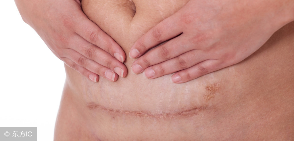 剖腹产婆婆让生三胎,剖腹产一胎女孩婆婆让生二胎