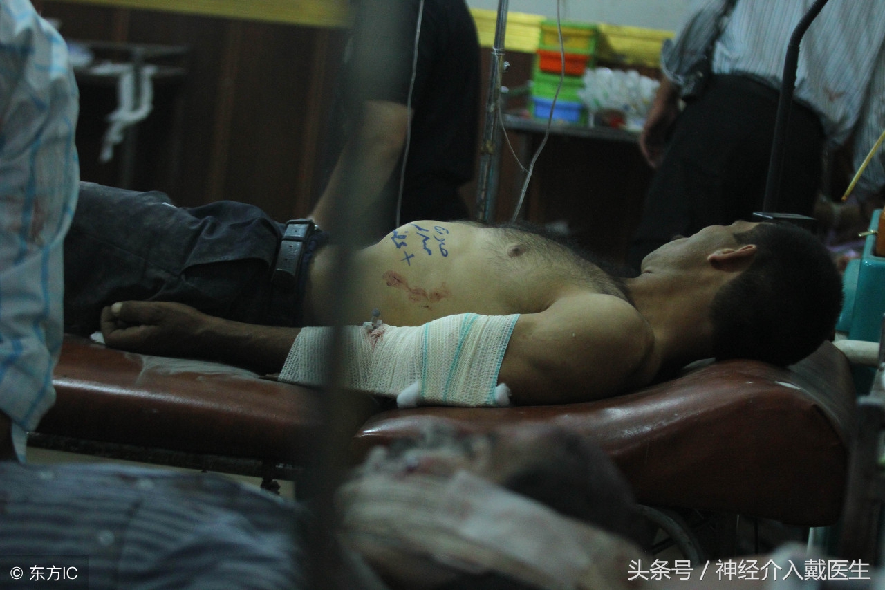 脑外伤瞳孔一大一小怎么回事,脑血管意外双侧瞳孔消失