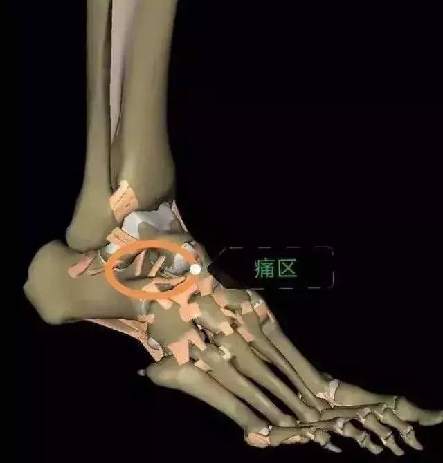 跗骨窦损伤需要多久恢复,跗骨窦韧带损伤应该做什么检查