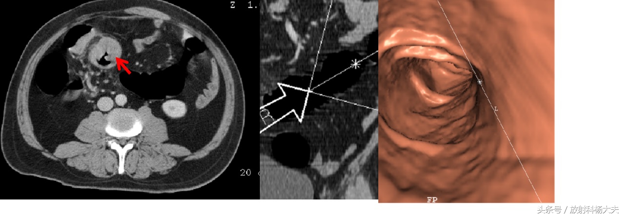 结直肠癌早期筛查还用做肠镜吗,用ct可以看清直肠息肉吗