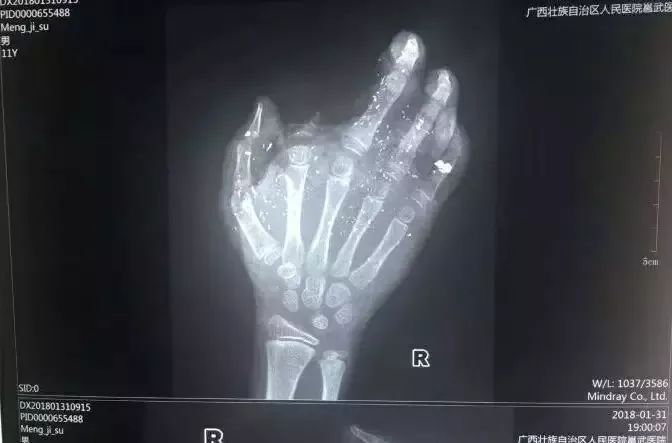 惊险瞬间男子在修手机时发生爆炸,一个小男孩玩手机爆炸搞笑视频